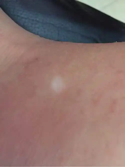 作者:南昌白癜风医院文章摘要:说起白癜风大家都会想起皮肤白斑,该