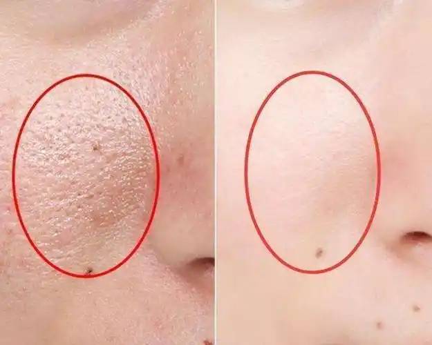 美聚智造:毛孔粗大怎么改善?四个小妙招让你过年回家无惧相亲