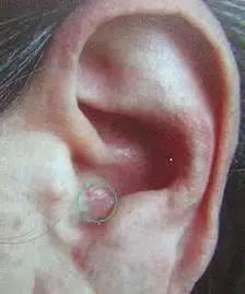 耳穴疾病反映点