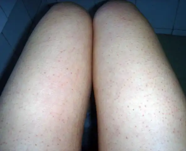 毛囊炎 可以用什么药物治疗