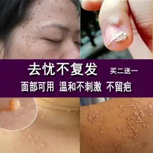 去扁平疣药膏