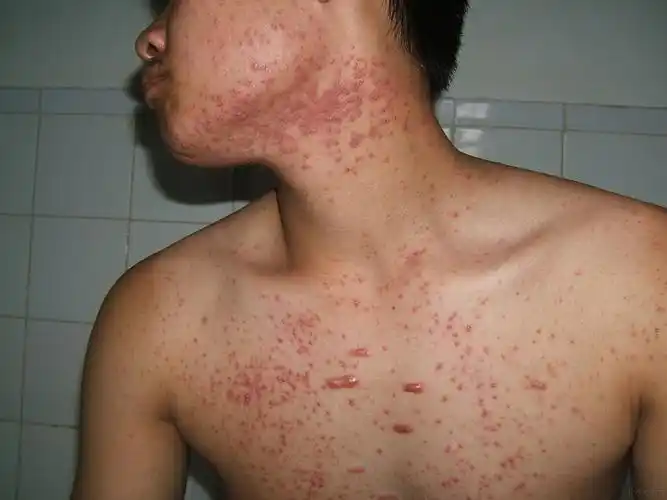 皮肤病2种情况同在