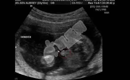 在b超中,怀孕第五个月的男孩和女孩有一个明显的区别:女孩可以看到