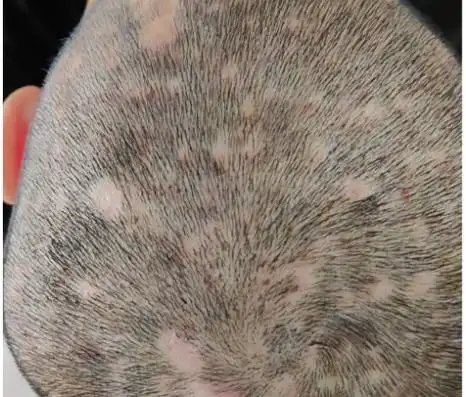 天气变热了 得毛囊炎的人也多了起来~~_郑州皮肤病专科医院_河南京城