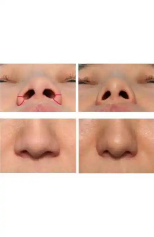 鼻翼缩小的方法有哪些