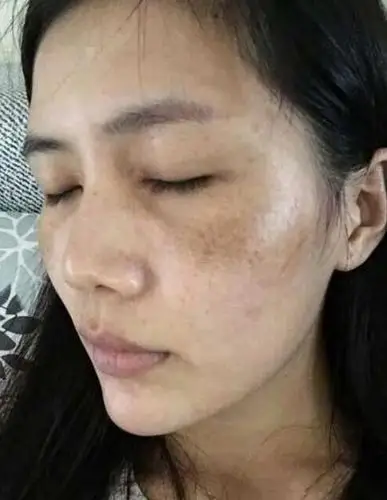 脸上长斑?红霉素软膏加它,斑点嗖嗖往下掉,祛斑比激光还好