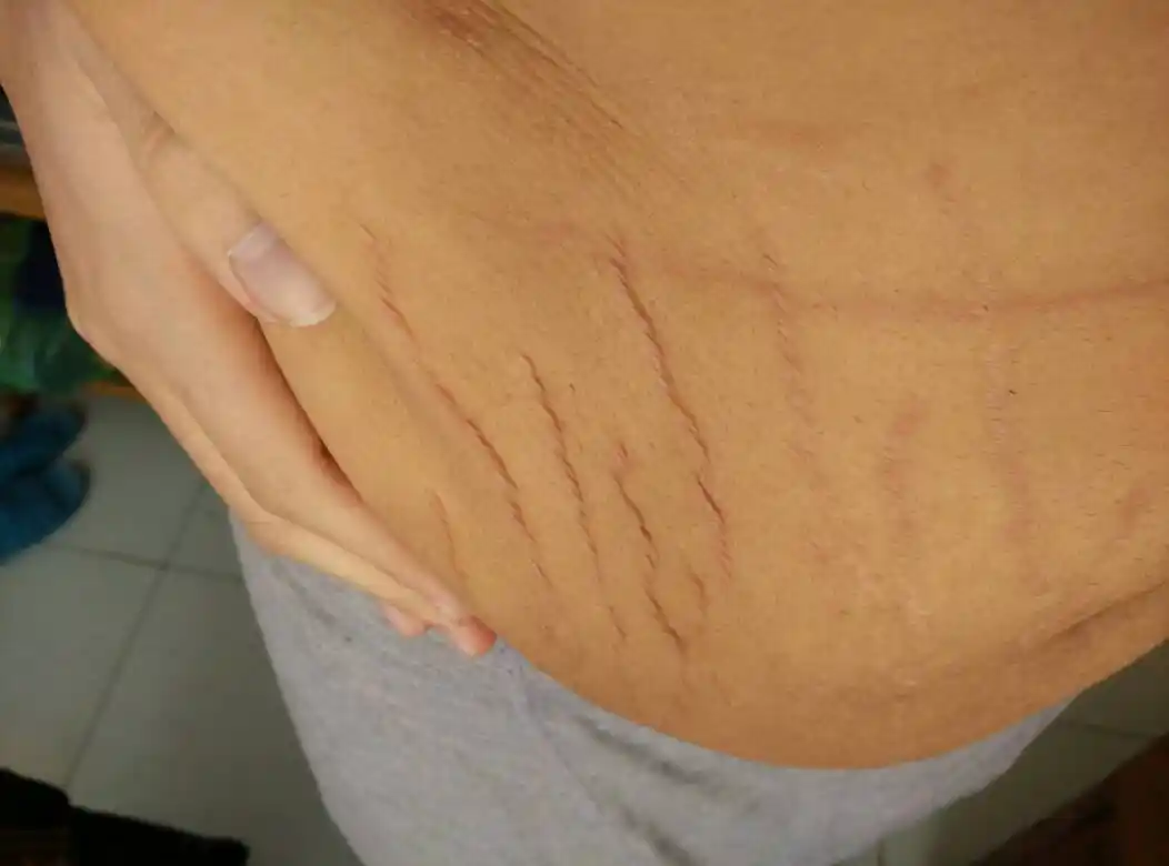 三个月减了七十多斤,现在身上的皮肤很松弛,特别是肚子,肚子里面没