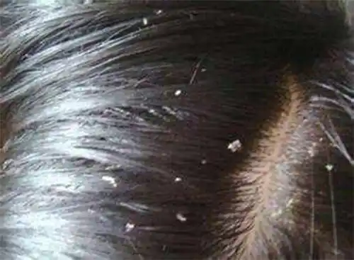 头发上很多细碎头皮屑,白泥,用手挠就能挠下来.