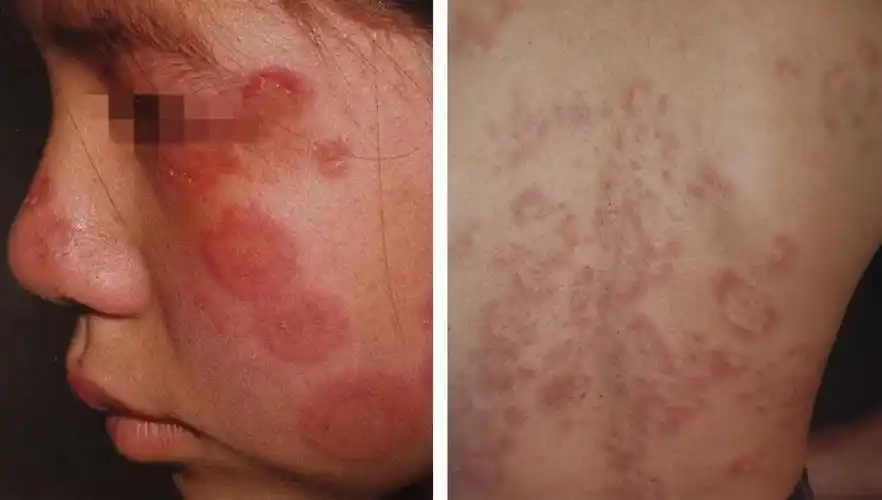 什么是狼疮性脂膜炎应该如何治疗