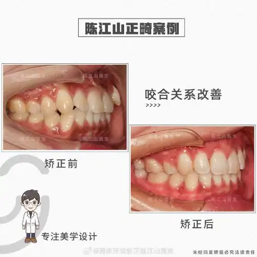 dr.chen美学正畸案例##健闻登顶计划##深圳牙齿矫正