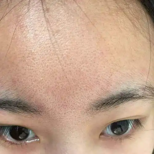 皮肤管理丨黑头 油脂 毛孔堵塞?水光净透亮颜管理的真实效果