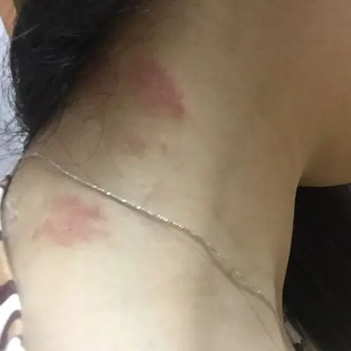 脖子上不知道什么时候长了三块红红的斑不痒这是怎么回事严