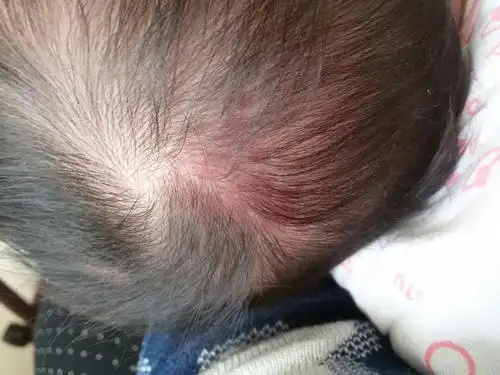 宝宝头上长了一块红红的,大家帮忙看一下!