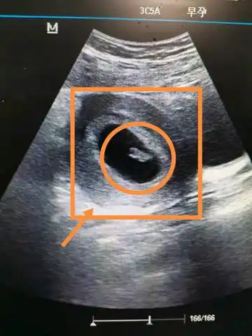 怀孕七周,今天做b超,检测胎心胎芽没问题,小肚子一侧疼,昨天下午开始