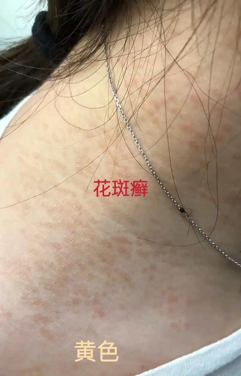 同一种真菌感染,引起不同皮肤病.花斑癣,又名花斑糠疹,俗称汗 - 抖音