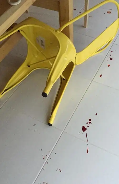 悉尼男子被椅子割断脚趾 有图慎入