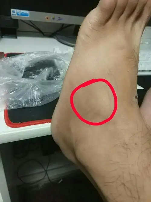 我的脚面经常在睡着的时候跟扭到一样的痛是怎么回事? - 知乎