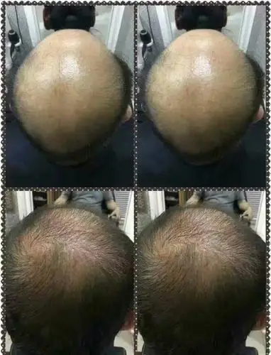 北京海林签约生发,无效退款