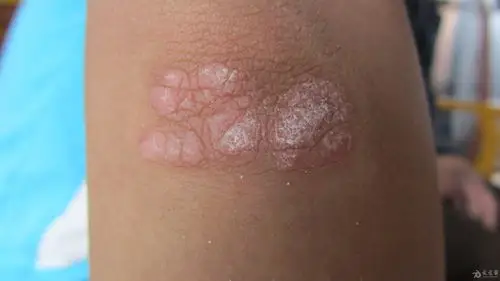 神经性皮炎 - 皮肤及性传播疾病讨论版 - 爱爱医医学论坛