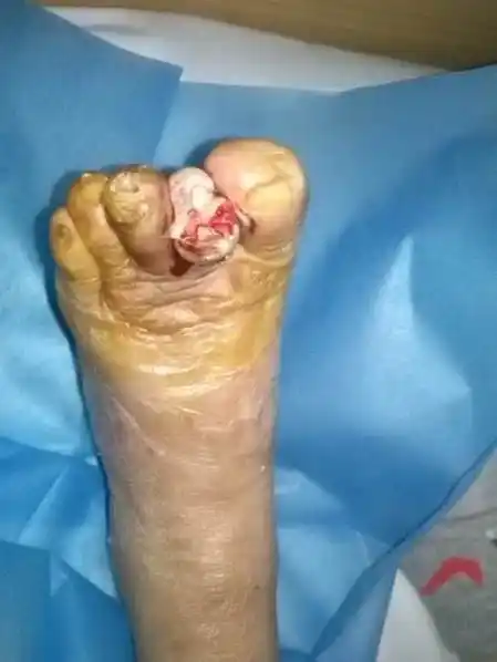 该患者本来在多家医院"已判"截肢,最终在我科保住肢体,住院时间约1月