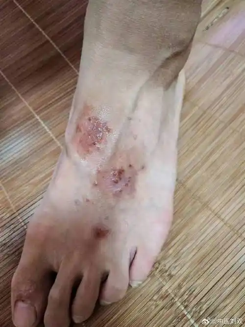 中医##湿疹#男,14岁,下肢皮肤干燥瘙痒,伴皮损1周,大的如铜钱,破舜Ζ