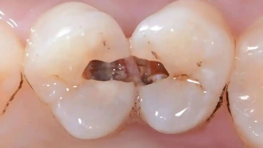 龋洞在侧面三,补牙后可以洗牙吗?补牙后一般情况下是可以洗牙的.