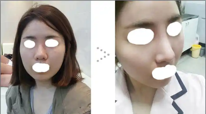 不赞啊    整个脸蛋精致超多了    而且鼻子也变得特别的美丽挺俏的呢