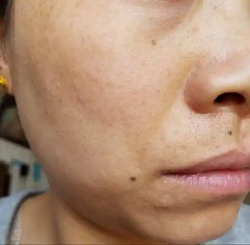 1洗完脸一擦干马上就有紧绷感2黑头白头很多毛孔粗大