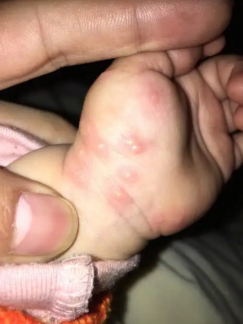 宝宝身上起水泡