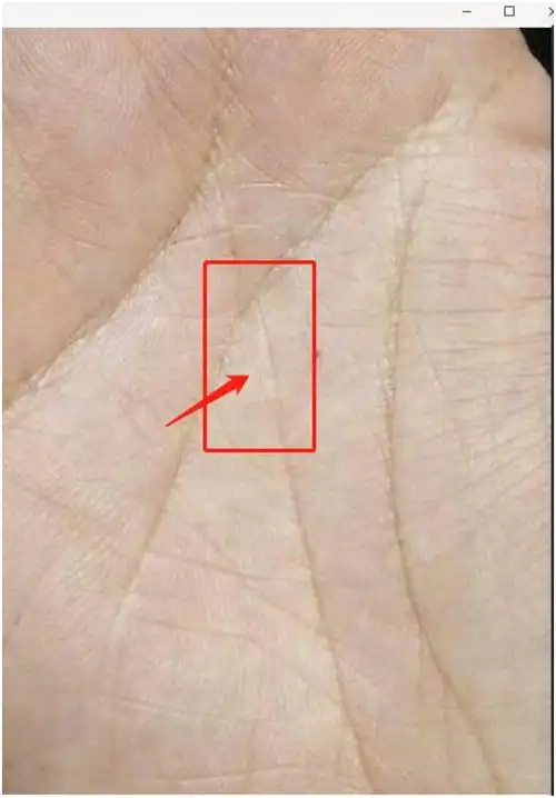 5线在明堂处终止,且顶端有竖长的岛纹:提示患有胃下垂