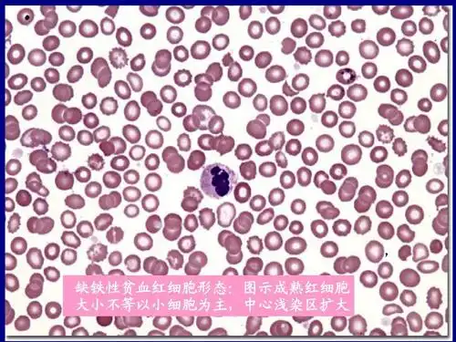 营养性贫血缺铁ppt 医学 儿科学 课件 讲义 , 缺铁性贫血红细胞形态