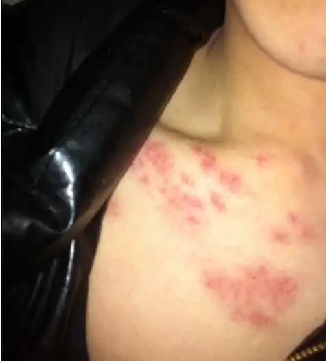 艾滋病图片_艾滋病症状表现图片大全_有来医生