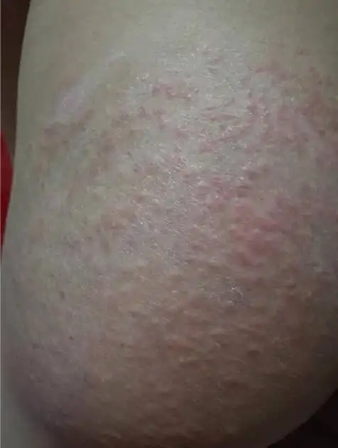 荃湾区湿疹医院_荃湾区治疗湿疹哪家医院好_荃湾区治疗湿疹权威的医院