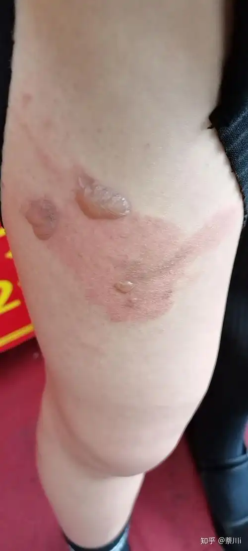 腿被烫了泡 - 知乎