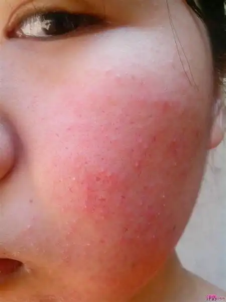 维e擦脸可以修复敏感皮肤吗