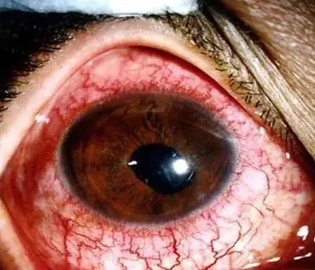 健康强直致残不仅表现在脊柱还有眼睛也要重点关注