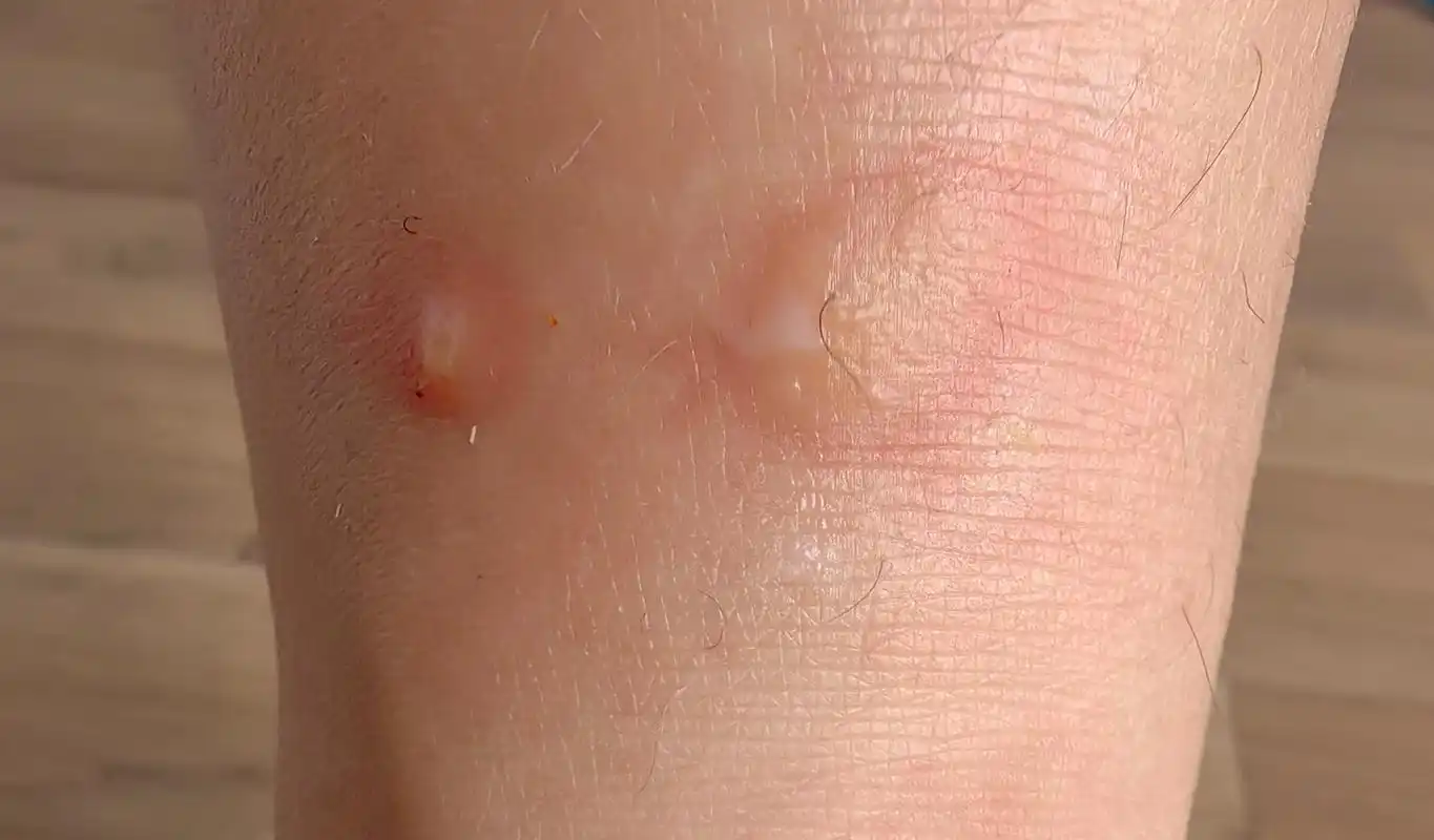 有谁懂被跳蚤咬的痛?