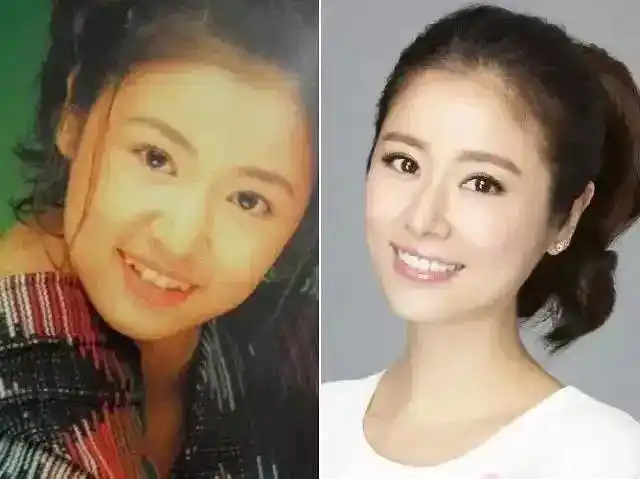 盘点娱乐圈因整牙变美的明星,最后一个你信吗?