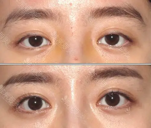 韩国眼部修复手术前后对比照片