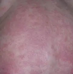 湿疹性皮炎图片