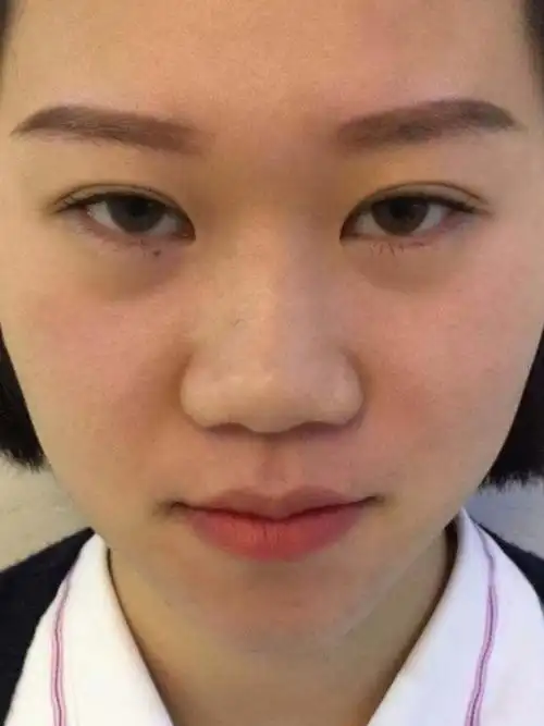 【原韩鼻部多项】我之前的鼻子鼻梁低,整个鼻翼特别宽,_圈子-新氧美容