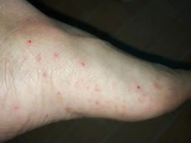 脚底长了很多小红点,抓的话会痒