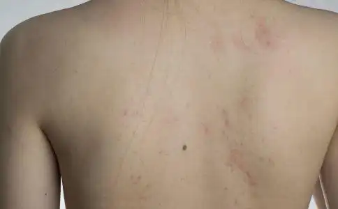 4个皮肤过敏的症状 你了解几个