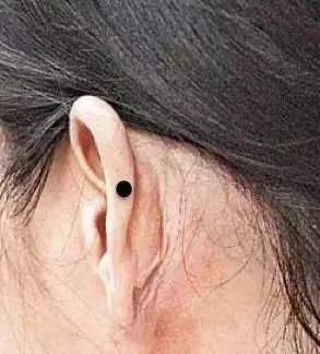 耳朵上长痣是吉祥的征兆吗