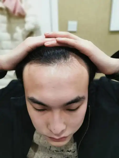 邵先生植发主要改善了额角,m型发际线消失,现在8个月发量爆棚,外形
