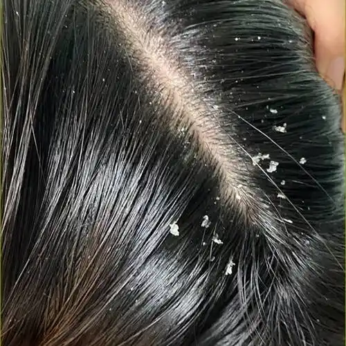 毛囊炎用什么洗发水好