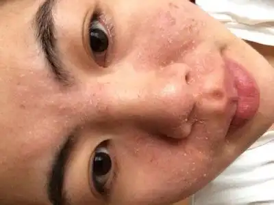 脸总干起皮怎么办