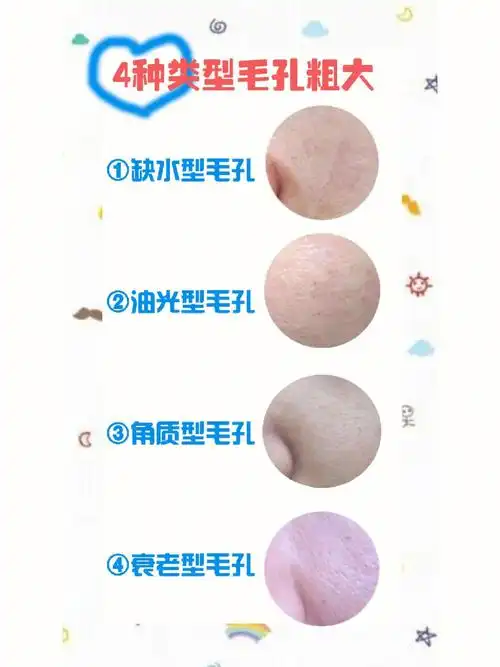 4种毛孔粗大类型认识与针对性护理