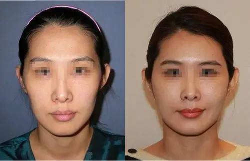 自体脂肪填充对比图