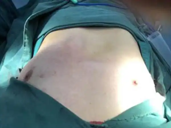 小孩子鸡胸图与正常胸型图对比有什么不同